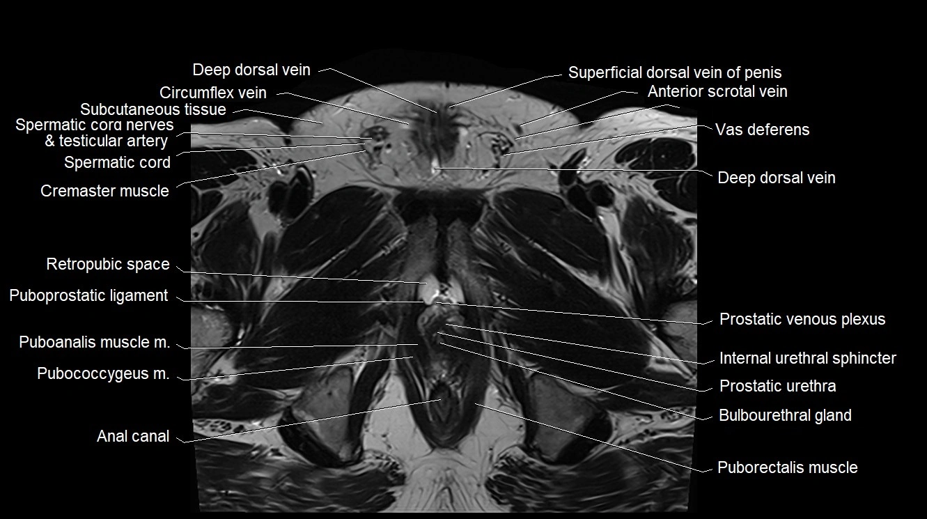 MRI 3T scrotum and penis axial cross sectional anatomy image 13.webp